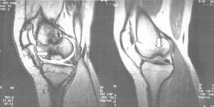 x-ray of osteochondrosis in the knee joint