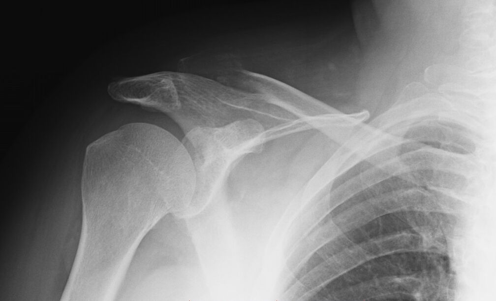 shoulder arthropathy x-ray
