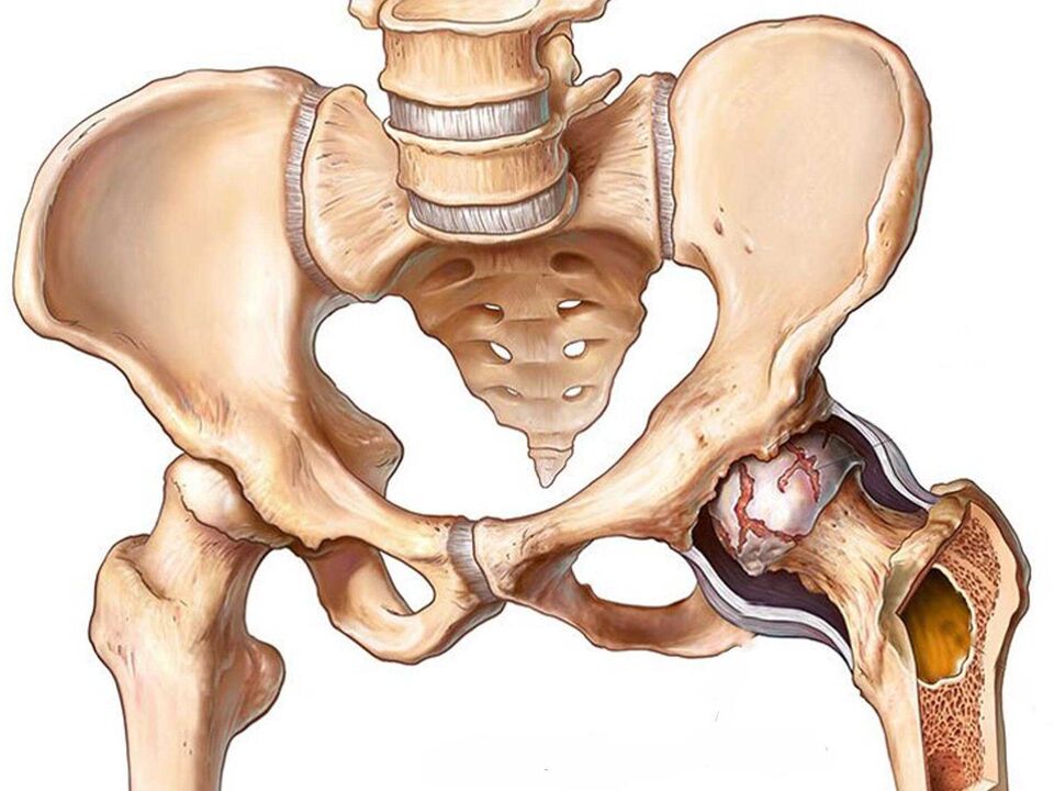 arthropathy of the hip joint