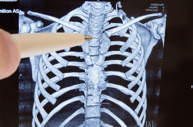 Osteochondria