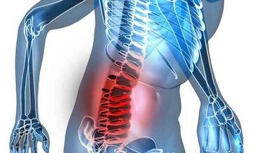 Signs and symptoms of lumbar osteochondic