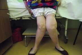 advanced arthropathy of the knee joint