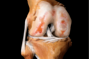 damage to the knee joint due to arthropathy